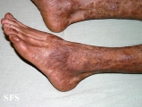pityriasis rubra pilaris