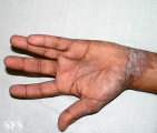 pityriasis rubra pilaris