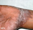 pityriasis rubra pilaris