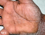 pityriasis rubra pilaris