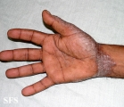 pityriasis rubra pilaris