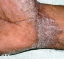 pityriasis rubra pilaris
