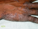 pityriasis rubra pilaris