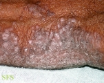 pityriasis rubra pilaris