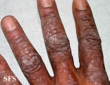 pityriasis rubra pilaris