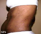 pityriasis rubra pilaris