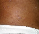 pityriasis rubra pilaris