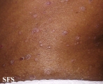 pityriasis rubra pilaris