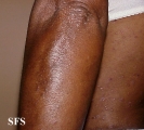 pityriasis rubra pilaris