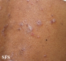 pityriasis rubra pilaris