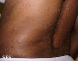 pityriasis rubra pilaris
