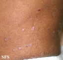 pityriasis rubra pilaris