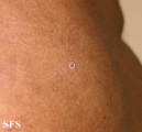 pityriasis rubra pilaris