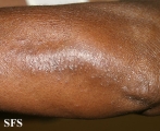 pityriasis rubra pilaris