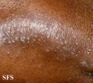 pityriasis rubra pilaris