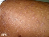 pityriasis rubra pilaris
