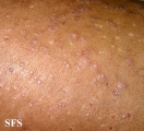 pityriasis rubra pilaris