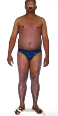 pityriasis rubra pilaris