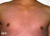 pityriasis rubra pilaris