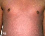 pityriasis rubra pilaris