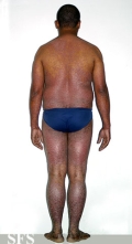 pityriasis rubra pilaris