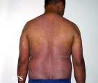 pityriasis rubra pilaris