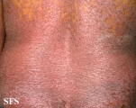 pityriasis rubra pilaris