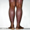 pityriasis rubra pilaris