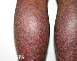 pityriasis rubra pilaris
