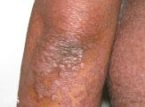 pityriasis rubra pilaris