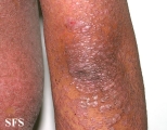 pityriasis rubra pilaris