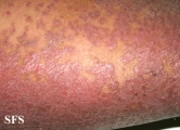 pityriasis rubra pilaris