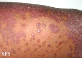 pityriasis rubra pilaris