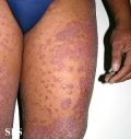 pityriasis rubra pilaris