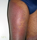 pityriasis rubra pilaris
