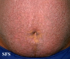 pityriasis rubra pilaris