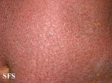 pityriasis rubra pilaris