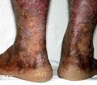 pityriasis rubra pilaris