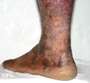 pityriasis rubra pilaris