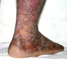 pityriasis rubra pilaris