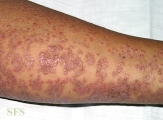 pityriasis rubra pilaris