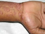 pityriasis rubra pilaris