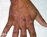 pityriasis rubra pilaris