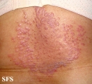 pityriasis rubra pilaris