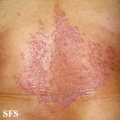 pityriasis rubra pilaris