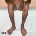 pityriasis rubra pilaris