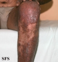 pityriasis rubra pilaris