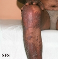 pityriasis rubra pilaris