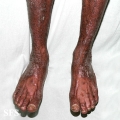 pityriasis rubra pilaris