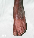 pityriasis rubra pilaris